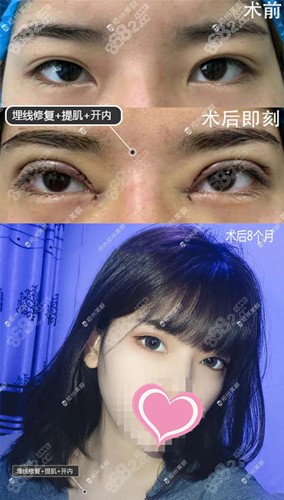 <!--<i data=20240705-sp></i>-->双眼皮修复实例