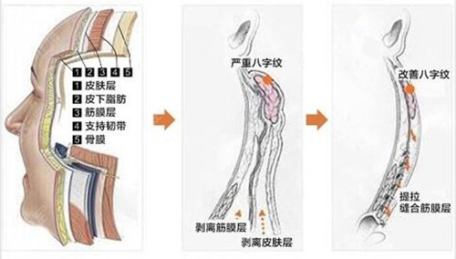 成都军建医院拉皮手术原理