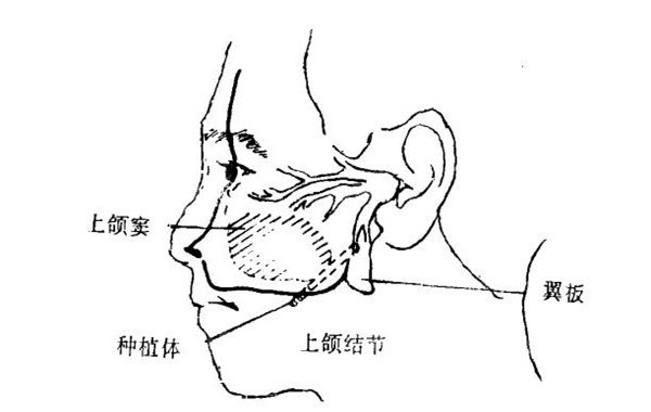 穿翼板种植牙示意图