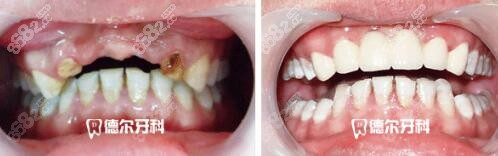 兰州德尔牙科门诊部种植牙改善照片