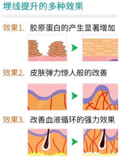 埋线提升的功效