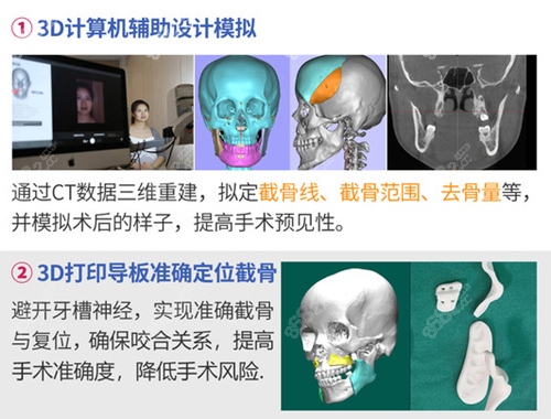 广大医院3D导板技术
