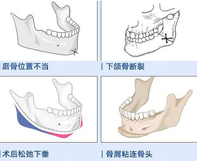 下颌角哪些问题要进行改善