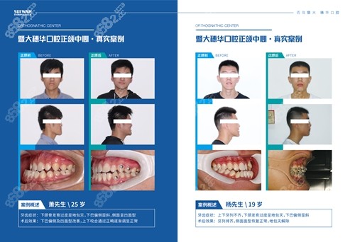 广州穗华口腔医院正畸联合正颌术后照片