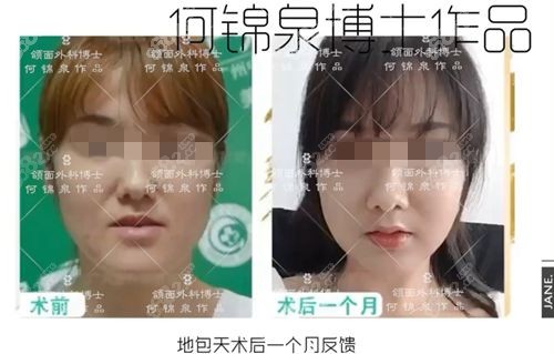 何锦泉地包天矫正对比照