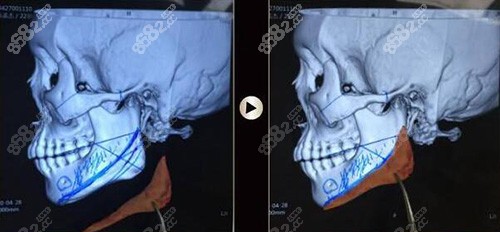 3D磨骨卡通照片