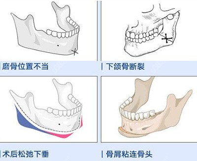 下颌角改善卡通照片