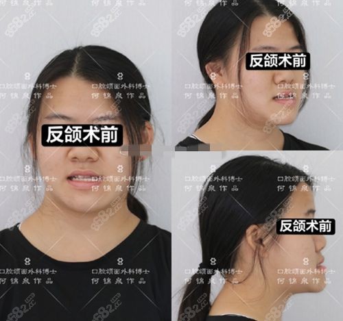 何锦泉正颌对比照