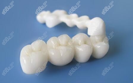 牙冠修复材料照片