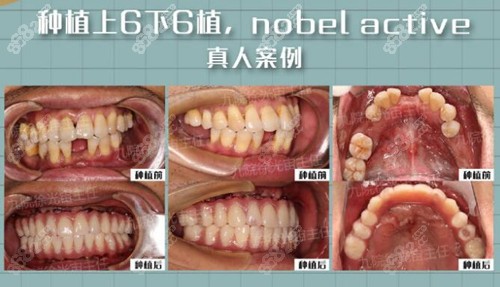 徐光宙种植牙前后对比照