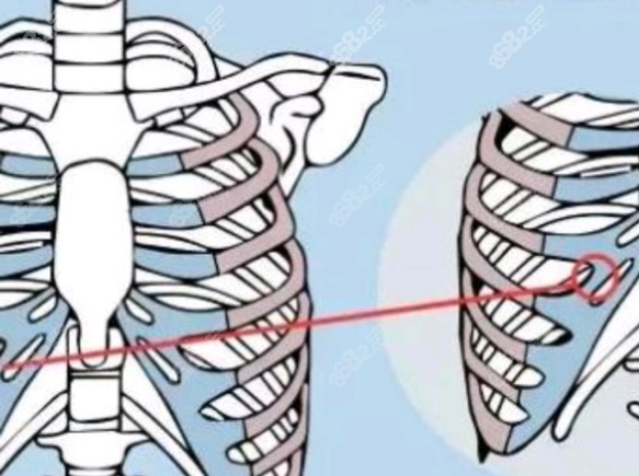 肋软骨钙化示意图