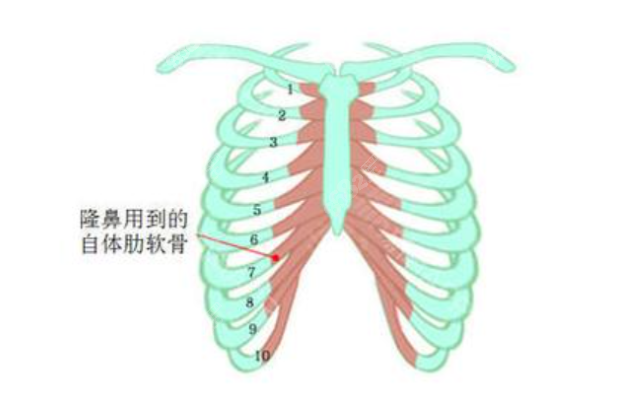 肋软骨隆鼻手术所需肋骨示意图