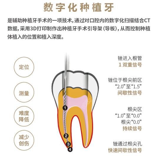 上海健皓口腔数字化种植牙优势