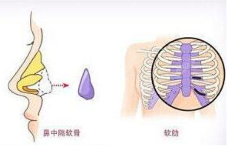 肋软骨隆鼻手术示意图