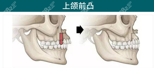 广州广大上颌前凸手术方案