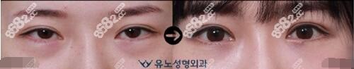 韩国修复双眼皮厉害的医生都有谁