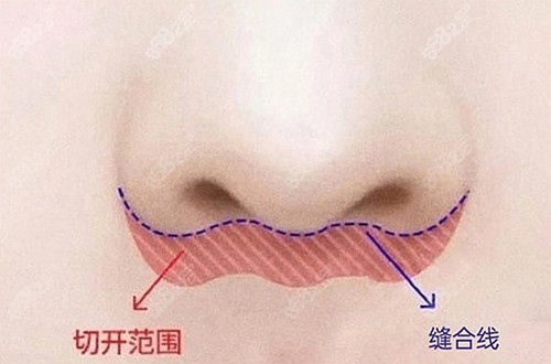 人中缩短手术的切口