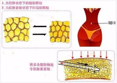 冯斌做吸脂手术的切口隐蔽