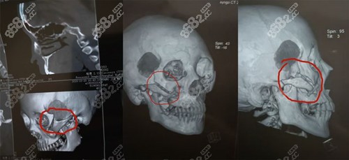 面诊前都需要做CT查看颧骨情况