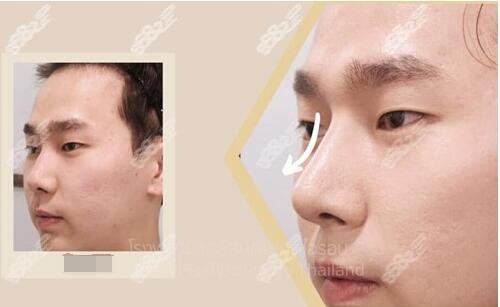 韩国艾恩整形外科男士隆鼻对比照