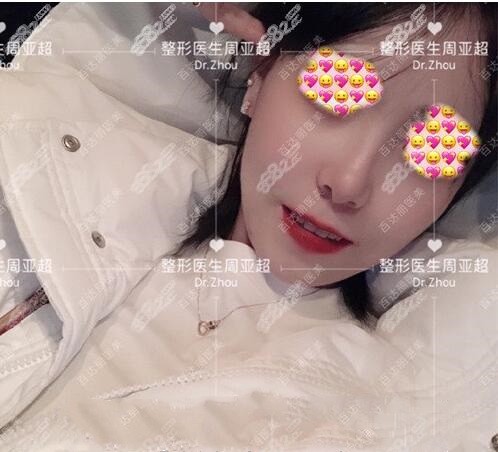 上海周亚超面部脂肪填充
