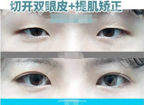 韩国歌娜整形外科双眼皮提肌矫正对比照
