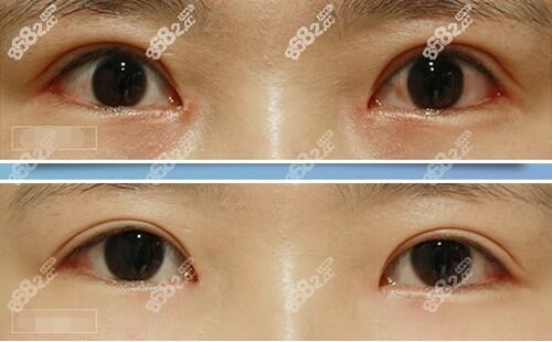 韩国双眼皮修复多少钱呢