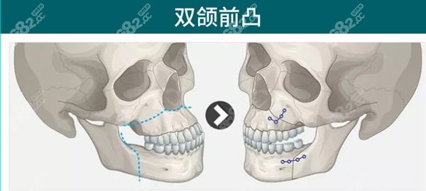 广州广大双颌前凸手术方案