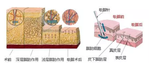 成都军建吸脂怎么样呢