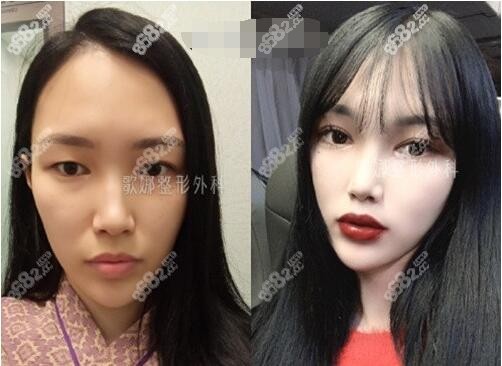 韩国歌娜整形外科双眼皮手术疗效图