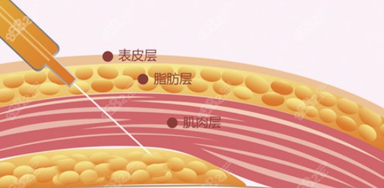 张立彬医生做脂肪填充后针眼小