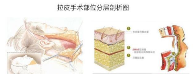 深圳拉皮手术哪里好？深圳鹏程小切口挺好