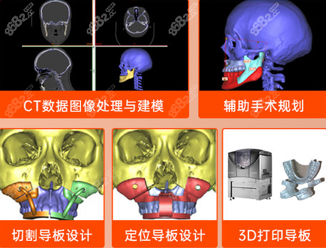 上海<!--<i data=20240705-sp></i>-->做正颌怎么样？3D打印导板技术等优势了解