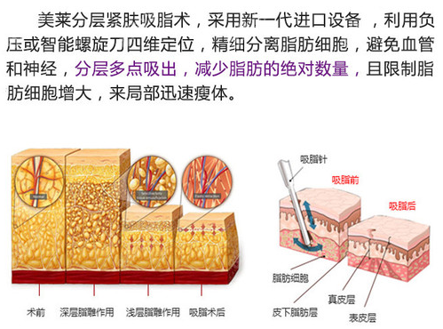 郑州美莱分层螺旋式吸脂术