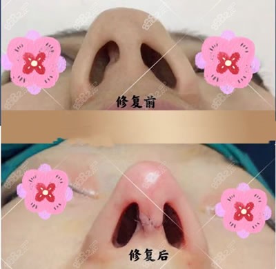 武汉亚韩整形外科医院鼻部整形鼻修复图