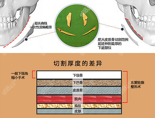 李运峰医生做下颌角怎么样