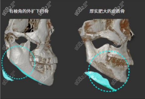 重庆<!--<i data=20240705-sp></i>-->做的1小时下颌角缩小术