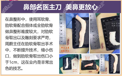 郑州美莱达 拉斯半肋软骨隆鼻术