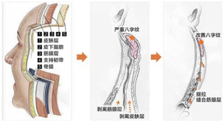 成都军建医院（整形美容）小切口拉皮