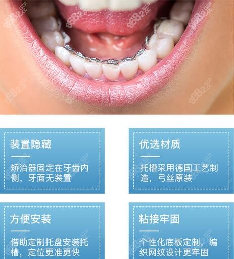 广州舌侧隐形牙齿矫正费用