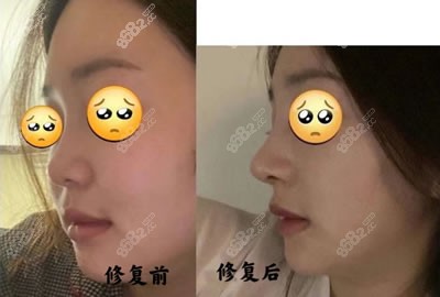 北京艾玛整形医疗美容鼻修复图