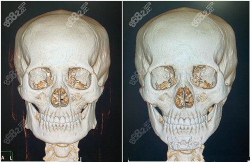 李运峰的下颌角手术前后对比图