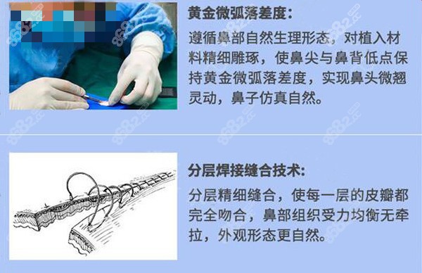 宫医生做隆鼻时的缝合和鼻尖处理