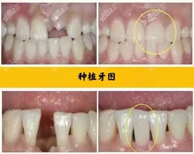北京钛植口腔医院种植牙图