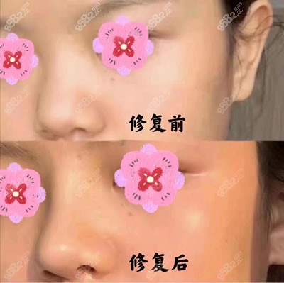 北京美莱医疗美容医院鼻修复图