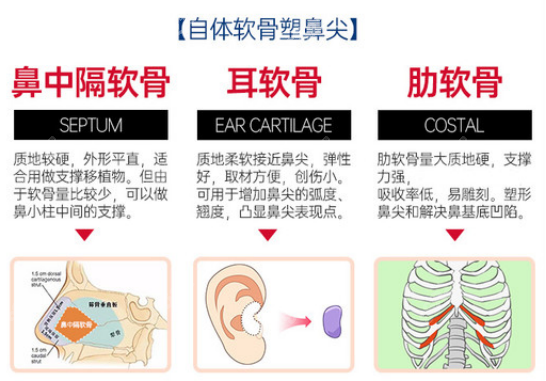 自体软骨隆鼻