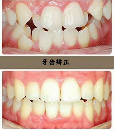 深圳雅医生口腔诊所牙齿矫正图