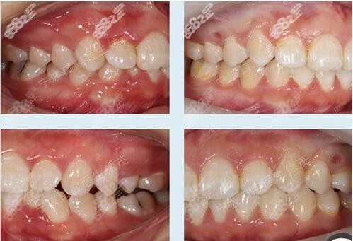 宁波新起点徐茂口腔牙齿矫正