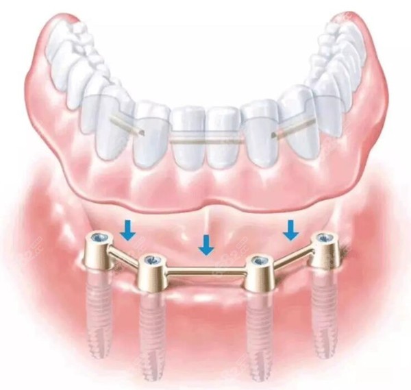 全口半固定种植牙