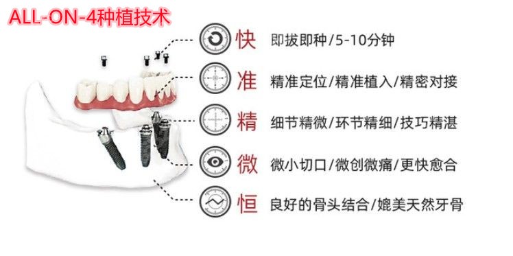 雅度口腔AII-ON-4即拔即种种植牙技术